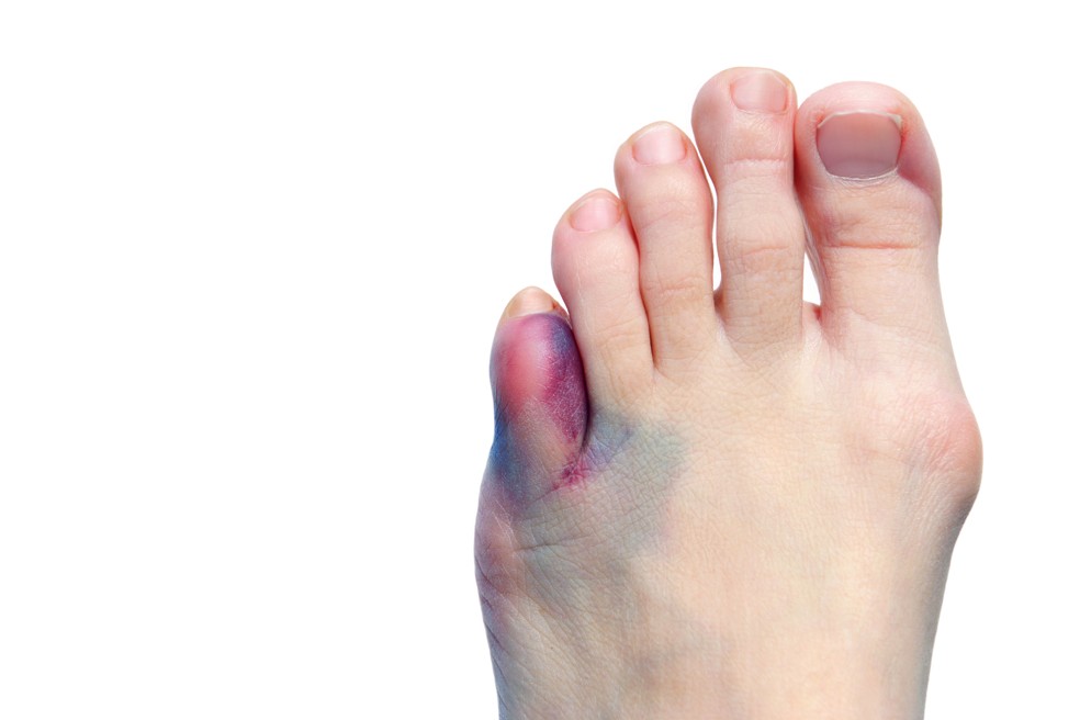 Jak se řeší zlomenina prstu na noze?